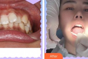 合肥劉大夫美容整形醫(yī)院羅永祥整形價格表附隱形托槽矯正案例展示