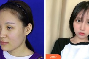 達州李雙均醫(yī)療美容門診部李雙均整形價格表附創(chuàng)可貼面部吸脂瘦臉案例展示