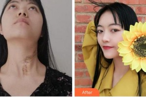 成都醫(yī)學院第一附屬醫(yī)院燒傷整形科馬兵整形價格表附祛疤案例展示