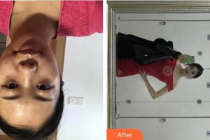 成都大華醫(yī)學美容醫(yī)院吳振裘整形價格表附點陣激光案例展示