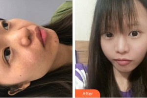 成都醫(yī)學院第一附屬醫(yī)院燒傷整形科劉漪淪整形價格表附祛疤案例展示