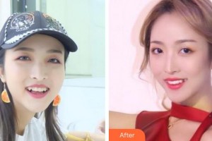 成都醫(yī)美整形美容醫(yī)院劉玉林整形價格表附隱形托槽矯正案例展示