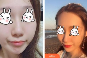 成都第六人民醫(yī)院醫(yī)學整形美容科趙蓉整形價格表附無針水光案例展示