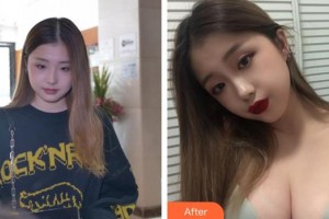 成都瑞美薈醫(yī)療美容醫(yī)院薛瑞整形價格表附假體隆胸案例展示