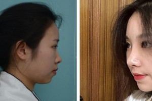 成都花田醫(yī)療美容門診部肖立范整形價格表附鼻部手術(shù)案例展示