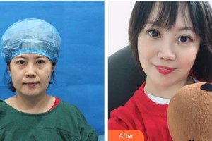 成都莊醫(yī)生醫(yī)學美容診所管太軍整形價格表附不開刀祛眼袋+自體脂肪填充淚案例展示