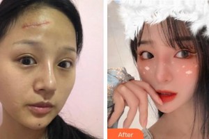 成都醫(yī)學院第一附屬醫(yī)院燒傷整形科劉月明整形價格表附離子束祛疤案例展示