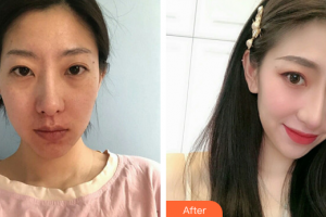 廣州膚美美容醫(yī)院夏雪形象設(shè)計師整形價格表附光子嫩膚案例展示