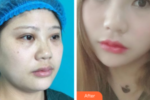 廣州壹加壹美容醫(yī)院張紅艷整形價格表附面部吸脂案例展示