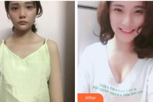 成都醫(yī)美整形美容醫(yī)院廖尚貴整形價格表附復合隆胸案例展示