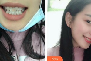 成都市第二人民醫(yī)院醫(yī)療美容科陳大夫整形價(jià)格表附半隱形牙齒矯正案例展示