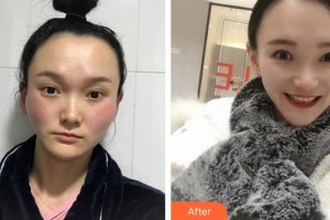 成都中華園整形美容醫(yī)院孫豪成整形價(jià)格表附顴骨顴弓案例展示