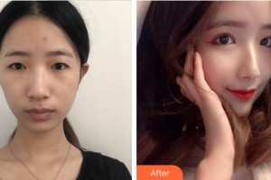 成都中華園整形美容醫(yī)院李猛整形價(jià)格表附眼部綜合案例展示