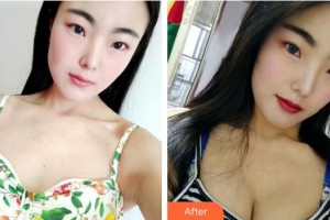 成都趙博士整形美容門(mén)診部趙善軍整形價(jià)格表附濃縮豐胸真實(shí)案例展示