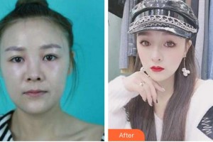 成都星尚美醫(yī)療美容門(mén)診部廖洪整形價(jià)格表附面包臉到鴨蛋臉變形記案例展示