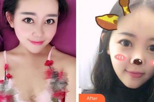 成都菲爾醫(yī)療美容門(mén)診部郝麗娜整形價(jià)格表附面部輪廓案例展示