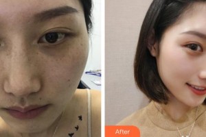 成都艾尚醫(yī)學(xué)美容門(mén)診部楊黎黎整形價(jià)格表附祛斑案例展示