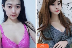 成都艾尚醫(yī)學(xué)美容門(mén)診部羅利達(dá)整形價(jià)格表附濃縮豐胸真實(shí)案例展示