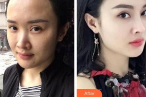 成都晶膚醫(yī)學(xué)美容醫(yī)院董薇薇整形價(jià)格表附抗皺案例展示