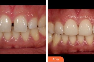 成都伊莎貝拉醫(yī)療美容門(mén)診部王殿玲整形價(jià)格表附瓷貼面一貼即白案例展示