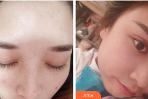 成都玉之光整形醫(yī)院陸藝整形價(jià)格表附祛斑案例展示