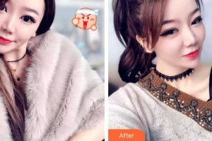 成都伊莎貝拉醫(yī)療美容門(mén)診部金鐘淵整形價(jià)格表附牙齒矯正案例展示