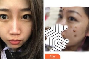 成都悅好醫(yī)學(xué)美容醫(yī)院陶曉蘋(píng)整形價(jià)格表附激光點(diǎn)痣案例展示