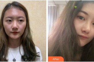 成都悅好醫(yī)學(xué)美容醫(yī)院文炯珍整形價(jià)格表附鼻部整形案例展示