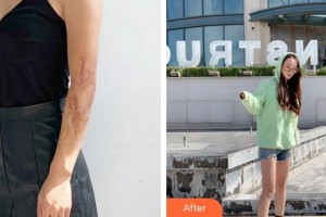 成都碧蓮盛植發(fā)診所袁國(guó)安整形價(jià)格表附手臂疤痕案例展示