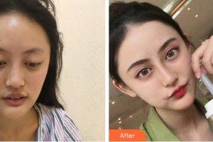 成都悅好醫(yī)學(xué)美容醫(yī)院韓炯逸整形價(jià)格表附鼻部手術(shù)案例展示