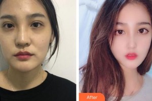 成都臺(tái)美仁仁醫(yī)學(xué)美容診所柯樹(shù)英整形價(jià)格表附鼻部手術(shù)案例案例展示