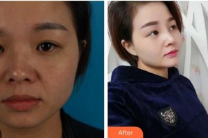 成都天使之翼醫(yī)學(xué)美容醫(yī)院郝勁偉整形價(jià)格表附鼻部綜合案例展示