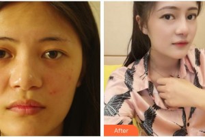 成都維莎芬美容整形醫(yī)院薛美思整形價(jià)格表附自體肋骨隆鼻案例展示