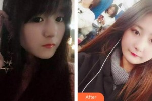 成都悅好醫(yī)學(xué)美容醫(yī)院徐凱整形價(jià)格表附牙齒根管調(diào)節(jié)案例展示