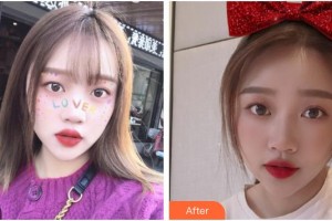 成都醫(yī)學(xué)院附屬整形美容醫(yī)院車墩發(fā)整形價(jià)格表附祛痘綜合案例展示