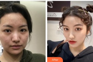 成都美瑞皮膚美容門診部馬維騏整形價(jià)格表附多方面部超激光美膚案例展示