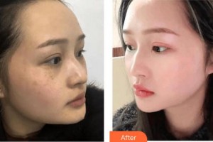 成都美瑞皮膚美容門診部黃紅琳整形價(jià)格表附激光祛斑案例展示