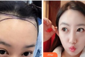 成都西區(qū)醫(yī)院醫(yī)學(xué)美容科蔡英整形價(jià)格表附發(fā)際線移植案例展示