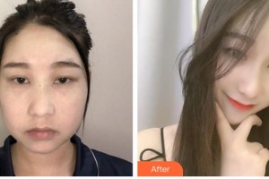 成都米蘭柏羽醫(yī)學(xué)美容醫(yī)院張峰整形價(jià)格表附埋線提升提升案例展示