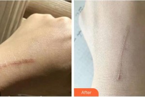 成都西區(qū)醫(yī)院醫(yī)學(xué)美容科王春聯(lián)整形價(jià)格表附祛疤案例展示