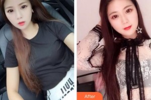 成都唯羅納醫(yī)療美容門診部張琪整形價(jià)格表附紅藍(lán)光祛痘案例展示