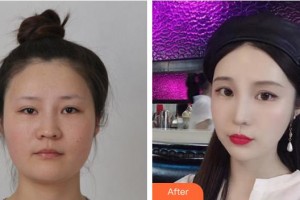 成都恒博醫(yī)院整形美容中心尹秉河整形價(jià)格表附頜面整形案例展示