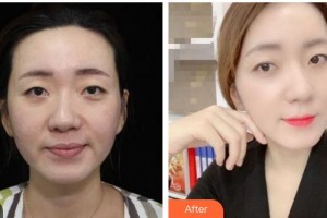 成都黃氏百佳整形醫(yī)院杜磊整形價(jià)格表附“熱瑪吉”多方面部提升案例展示