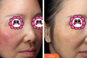 成都悅好醫(yī)學(xué)美容醫(yī)院楊翠霞整形價(jià)格表附祛紅血絲案例展示