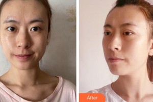 成都悅好醫(yī)學(xué)美容醫(yī)院高富雷整形價(jià)格表附眼部綜合案例展示