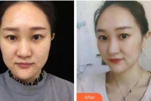 成都華倫鉑尚醫(yī)療美容診所蔣林君整形價(jià)格表附祛痘案例展示