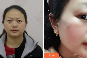 成都華康醫(yī)院美容整形外科劉可新整形價(jià)格表附面部疤痕修復(fù)案例展示