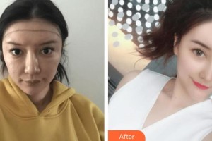 成都科發(fā)源醫(yī)療美容門診部王成玙整形價(jià)格表附發(fā)際線調(diào)整案例展示