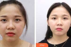 成都恒博醫(yī)院整形美容中心廖恒利整形價(jià)格表附祛斑案例展示