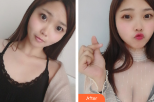 廣州美涵醫(yī)療整形美容醫(yī)院張成春整形價格表附自體脂肪隆胸案例展示